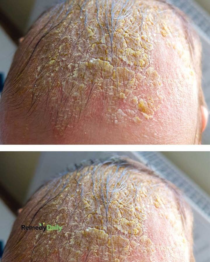 Oozing yellow crust on my scalp won’t heal. Clinic waitlist is long. What is it?. Full article